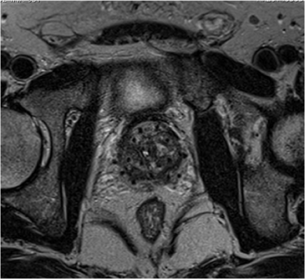 Prostate Cancer Patients Surveyed Five Years After Treatment With